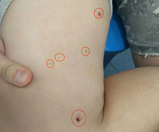 男子遭铁屑刺入大腿 学钢铁人用磁铁吸出险残疾